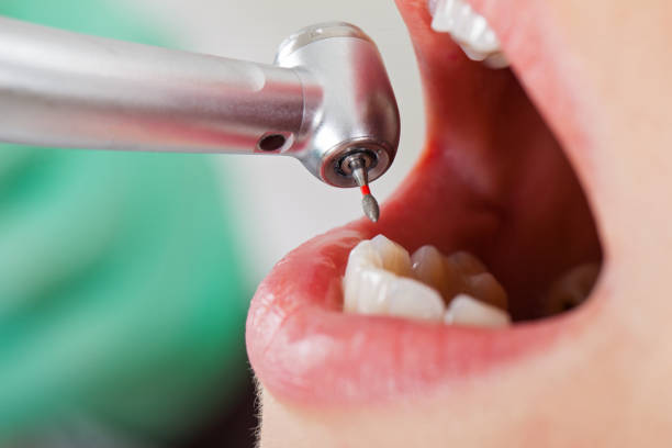 Best Emergency Wisdom Teeth Removal in Greensburg, KY